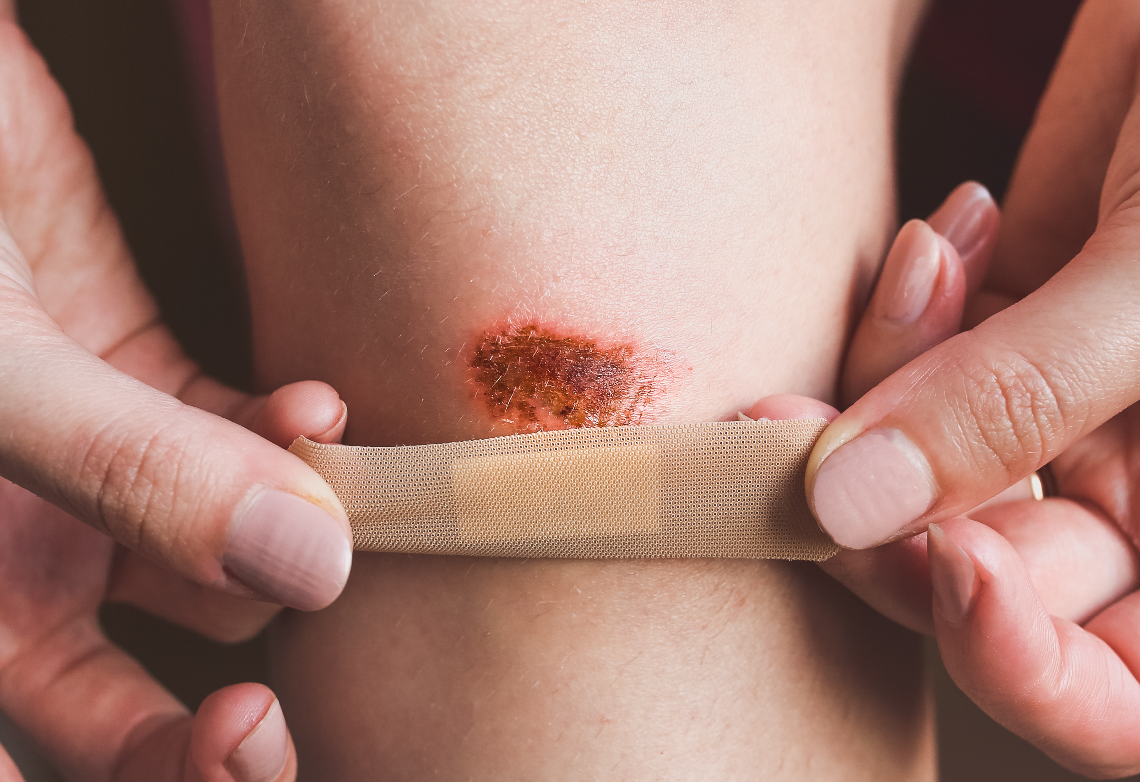 Abrasion on the woman's knee. Girl is applying antiseptic band-aid plaster on the injured leg with a red wound. Medical treatment.